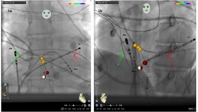 Reduction of Radiation Exposure in Atrioventricular Nodal Reentrant Tachycardia Ablations Using an Electroanatomical Mapping System With Fluoroscopy Integration Module